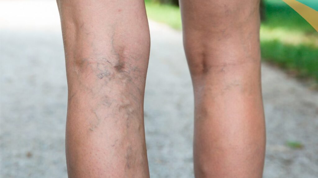 varices durante el embarazo